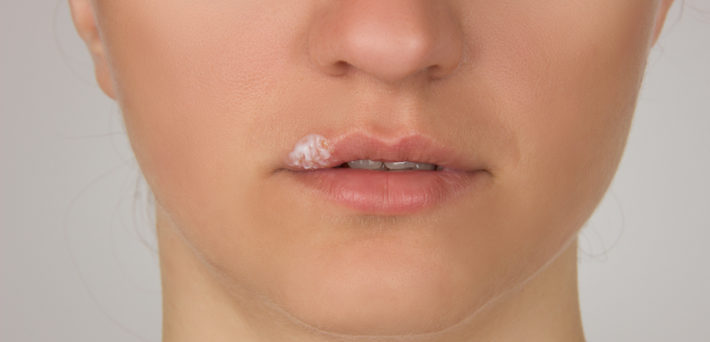 лечебная мазь на губе у женщины